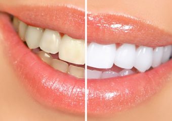 Blanqueamientos dentales profesionales